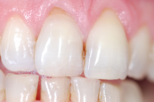 whitening-after