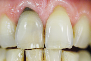 whitening-before