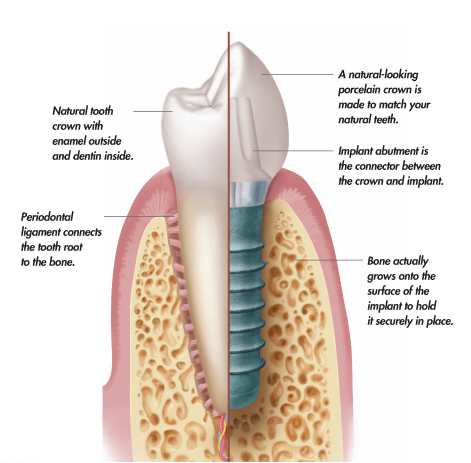 implant